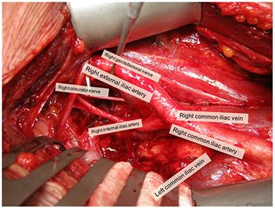 Comparison of Peri-operative and Early Oncological Outcomes of Robot-Assisted vs. Open Salvage Lymph Node Dissection in Recurrent Prostate Cancer